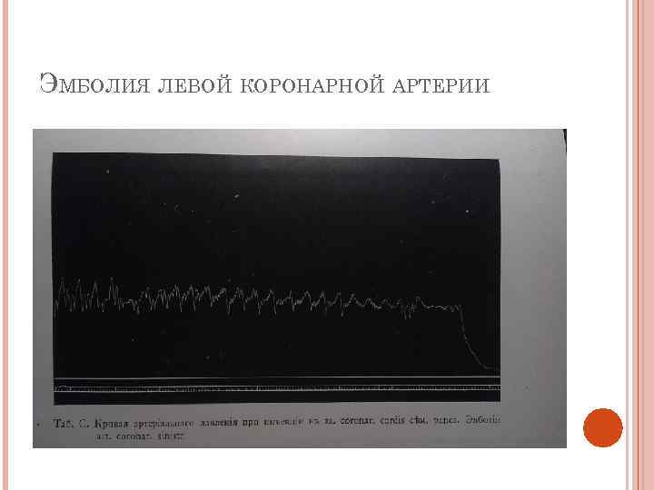 ЭМБОЛИЯ ЛЕВОЙ КОРОНАРНОЙ АРТЕРИИ 