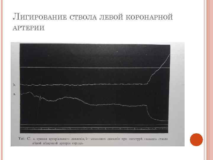 ЛИГИРОВАНИЕ СТВОЛА ЛЕВОЙ КОРОНАРНОЙ АРТЕРИИ 