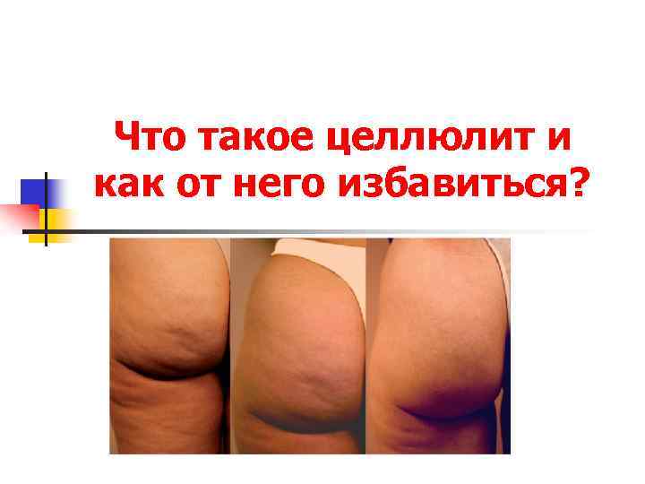 Что такое целлюлит и как от него избавиться? 