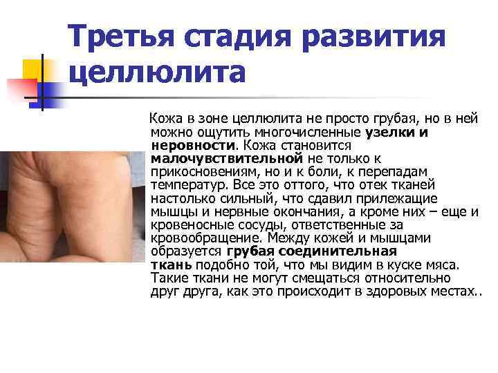 Третья стадия развития целлюлита Кожа в зоне целлюлита не просто грубая, но в ней