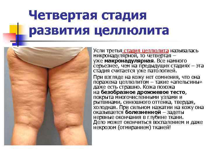 Четвертая стадия развития целлюлита n n Усли третья стадия целлюлита называлась микронадулярной, то четвертая