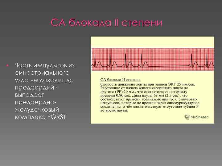 СА блокада II степени § Часть импульсов из синоатриального узла не доходит до предсердий