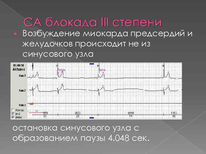 Синоатриальная блокада типы