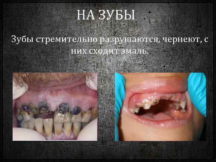 НА ЗУБЫ Зубы стремительно разрушаются, чернеют, с них сходит эмаль. 
