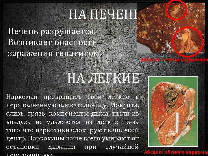 НА ПЕЧЕНЬ Печень разрушается. Возникает опасность заражения гепатитом. Абсцесс печени наркомана НА ЛЕГКИЕ Наркоман