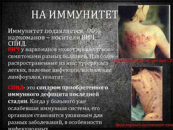 НА ИММУНИТЕТ Иммунитет подавляется, 90% наркоманов – носители ВИЧ, СПИД. ВИЧ у наркоманов может