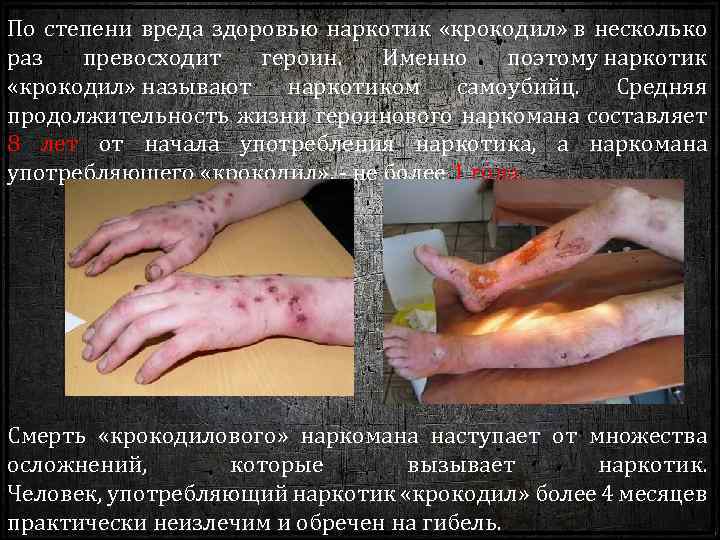 По степени вреда здоровью наркотик «крокодил» в несколько раз превосходит героин. Именно поэтому наркотик