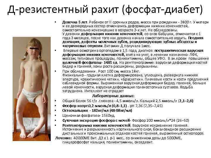 Д-резистентный рахит (фосфат-диабет) Девочка 5 лет. Ребенок от II срочных родов, масса при рождении