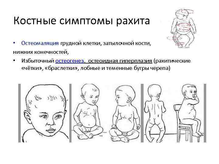 Костные симптомы рахита • Остеомаляция грудной клетки, затылочной кости, нижних конечностей, • Избыточный остеогенез,