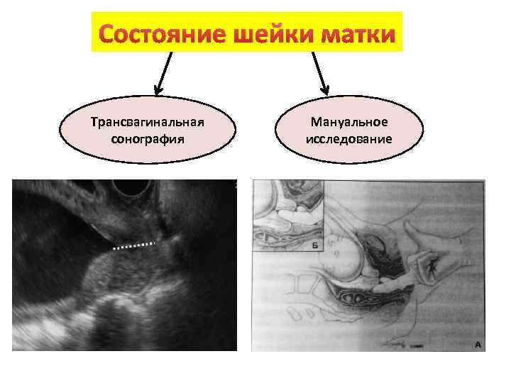 Состояние шейки матки Трансвагинальная сонография Мануальное исследование 