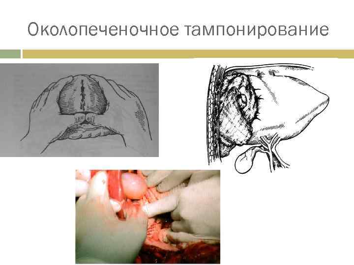 Околопеченочное тампонирование 