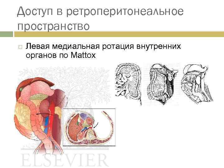 Доступ в ретроперитонеальное пространство Левая медиальная ротация внутренних органов по Mattox 