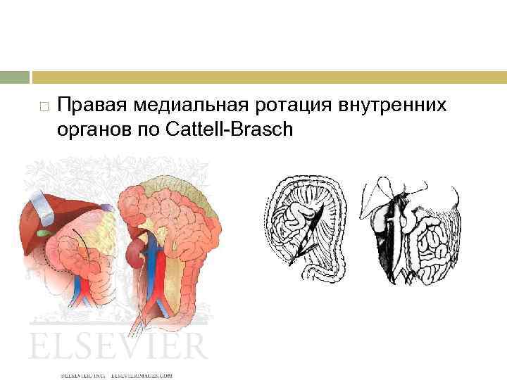  Правая медиальная ротация внутренних органов по Cattell-Brasch 