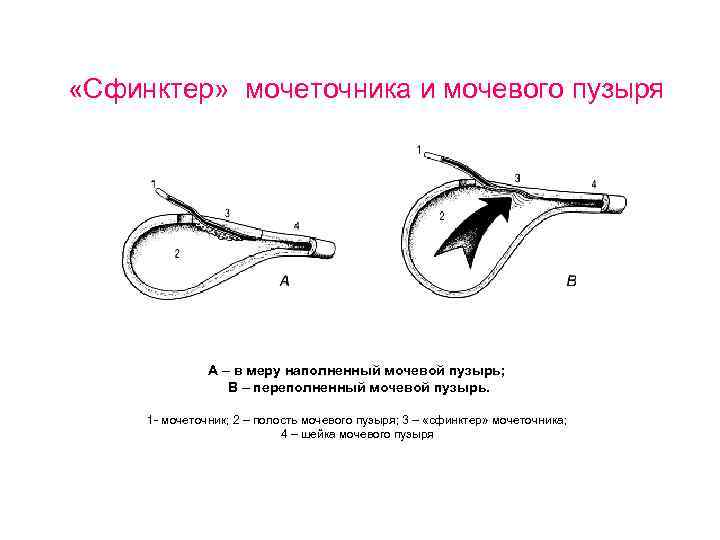  «Сфинктер» мочеточника и мочевого пузыря А – в меру наполненный мочевой пузырь; В