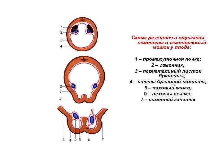 Схема развития и опускания семенника в семенниковый мешок у плода: 1 – промежуточная почка;