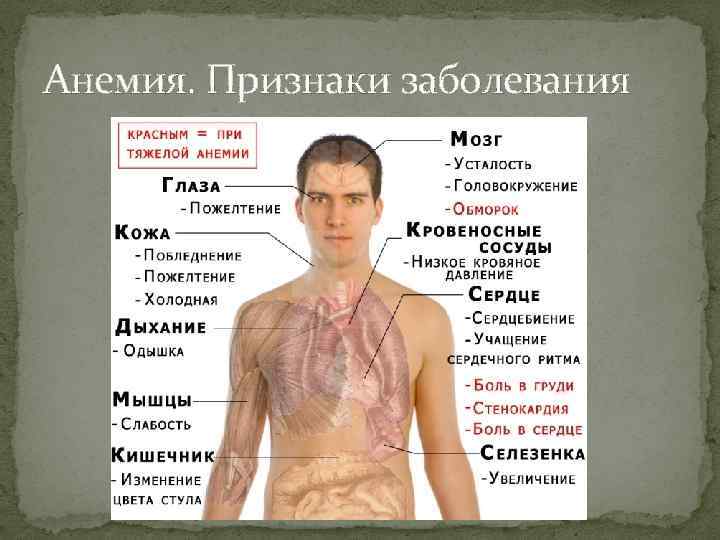 Анемия. Признаки заболевания 