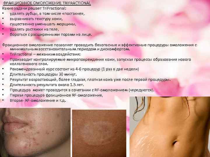  ФРАКЦИОННОЕ ОМОЛОЖЕНИЕ TRIFRACTIONAL Какие задачи решает Tri. Fractional: • удалять рубцы, в том