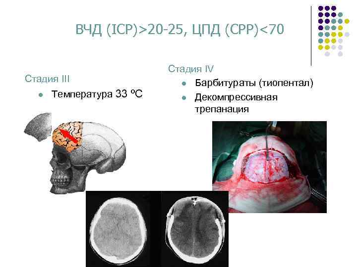 ВЧД (ICP)>20 -25, ЦПД (CPP)<70 Стадия III l Teмпература 33 ºC Стадия IV l