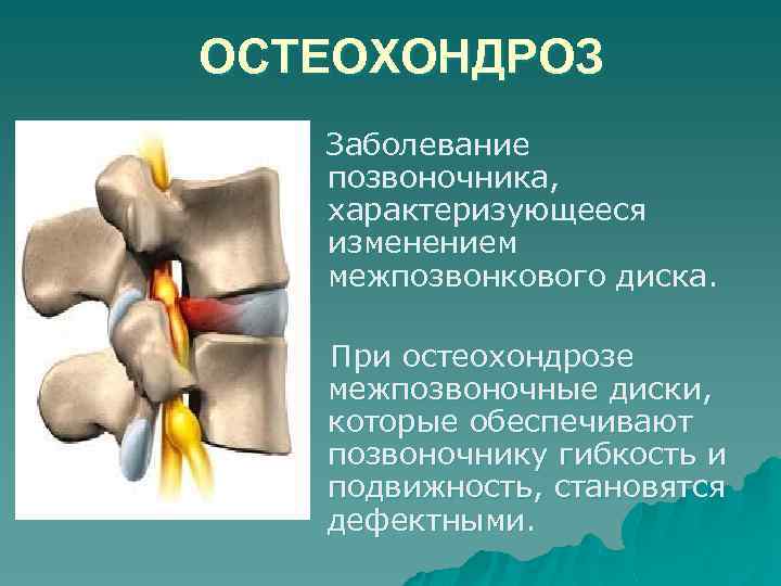 ОСТЕОХОНДРОЗ Заболевание позвоночника, характеризующееся изменением межпозвонкового диска. При остеохондрозе межпозвоночные диски, которые обеспечивают позвоночнику