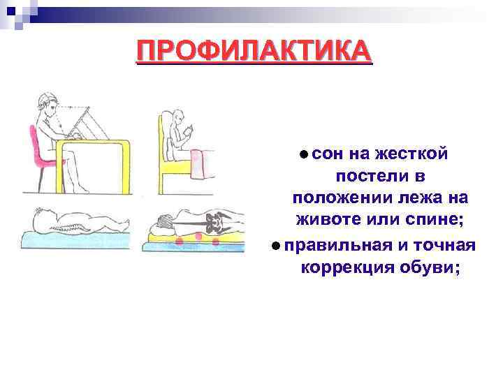 ПРОФИЛАКТИКА сон на жесткой постели в положении лежа на животе или спине; правильная и