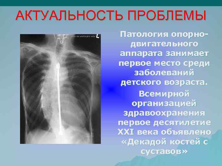 АКТУАЛЬНОСТЬ ПРОБЛЕМЫ Патология опорнодвигательного аппарата занимает первое место среди заболеваний детского возраста. Всемирной организацией