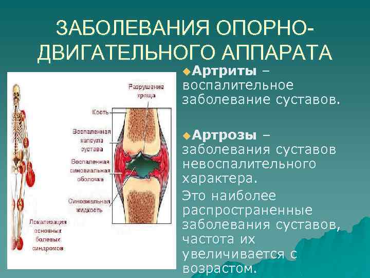 ЗАБОЛЕВАНИЯ ОПОРНОДВИГАТЕЛЬНОГО АППАРАТА u. Артриты – воспалительное заболевание суставов. u. Артрозы – заболевания суставов