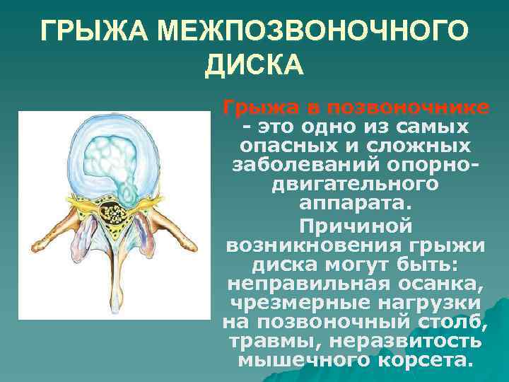 ГРЫЖА МЕЖПОЗВОНОЧНОГО ДИСКА Грыжа в позвоночнике - это одно из самых опасных и сложных