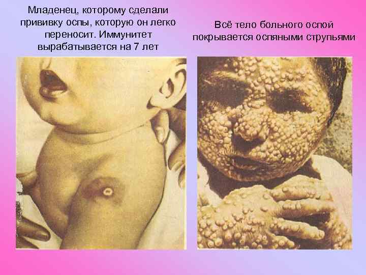 Младенец, которому сделали прививку оспы, которую он легко переносит. Иммунитет вырабатывается на 7 лет