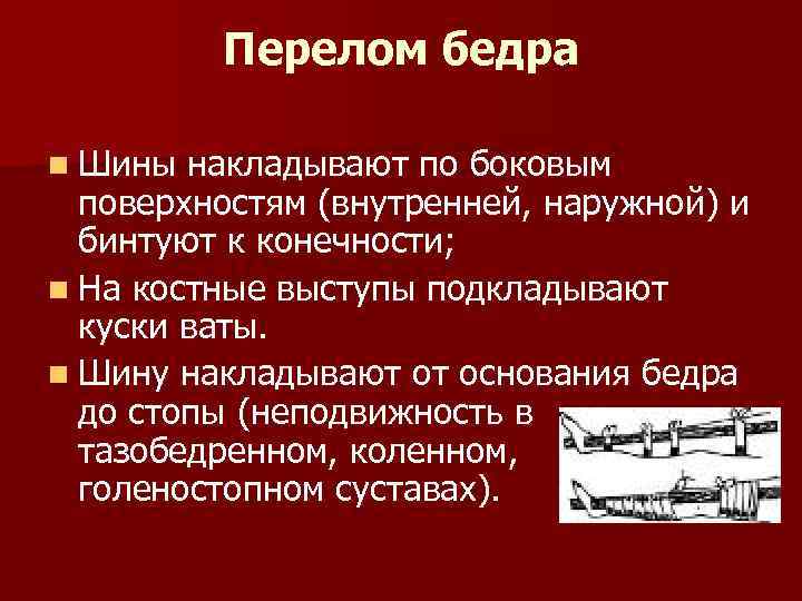 Перелом бедра n Шины накладывают по боковым поверхностям (внутренней, наружной) и бинтуют к конечности;