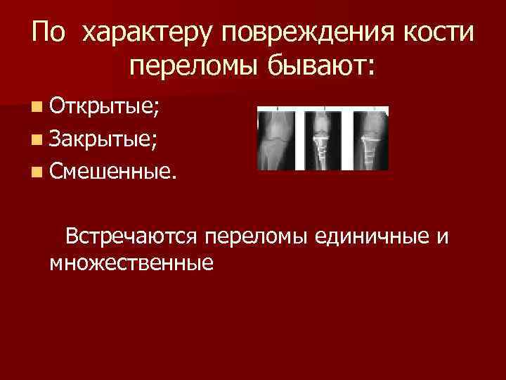 По характеру повреждения кости переломы бывают: n Открытые; n Закрытые; n Смешенные. Встречаются переломы
