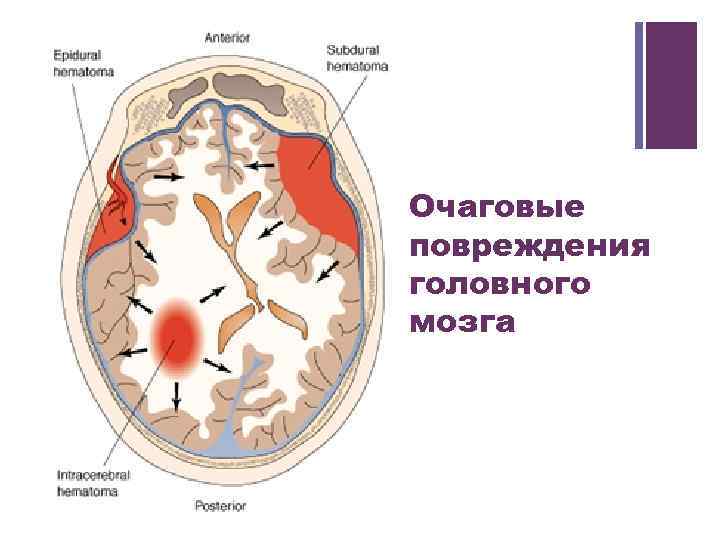 + Очаговые повреждения головного мозга 