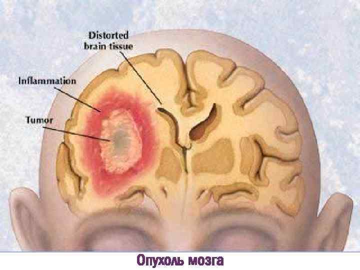 + Опухоль мозга 