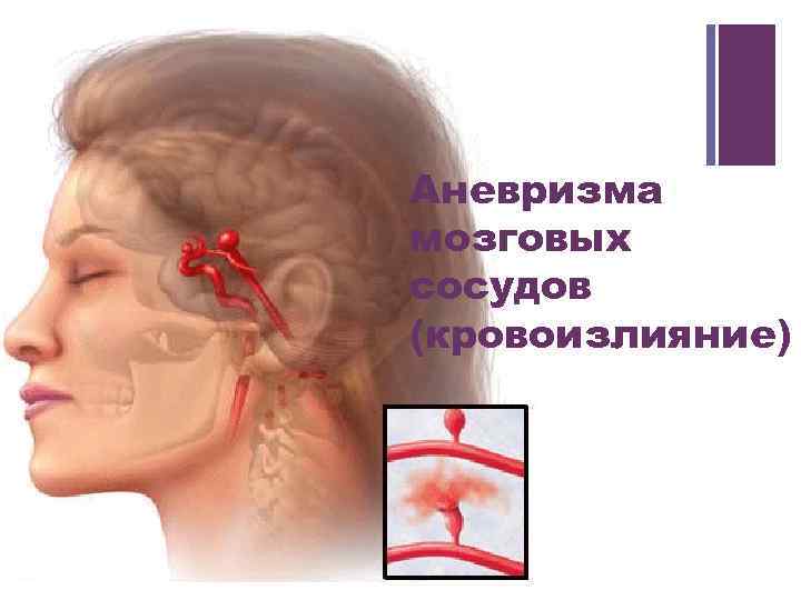 + Аневризма мозговых сосудов (кровоизлияние) 