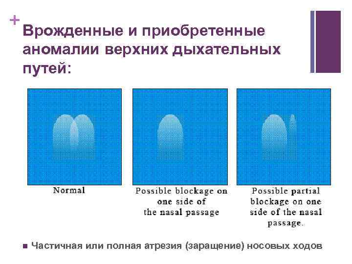 + Врожденные и приобретенные аномалии верхних дыхательных путей: n Частичная или полная атрезия (заращение)