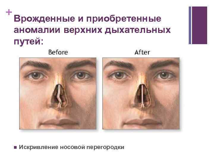 + Врожденные и приобретенные аномалии верхних дыхательных путей: n Искривление носовой перегородки 