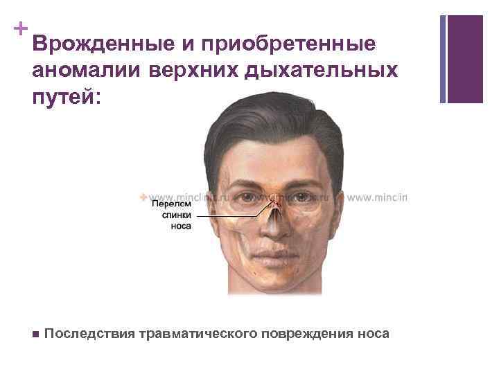 + Врожденные и приобретенные аномалии верхних дыхательных путей: n Последствия травматического повреждения носа 