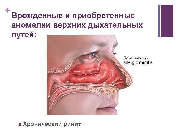 + Врожденные и приобретенные аномалии верхних дыхательных путей: n Хронический ринит 