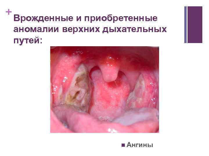 + Врожденные и приобретенные аномалии верхних дыхательных путей: n Ангины 