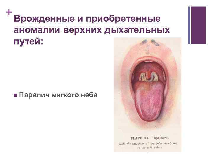 + Врожденные и приобретенные аномалии верхних дыхательных путей: n Паралич мягкого неба 