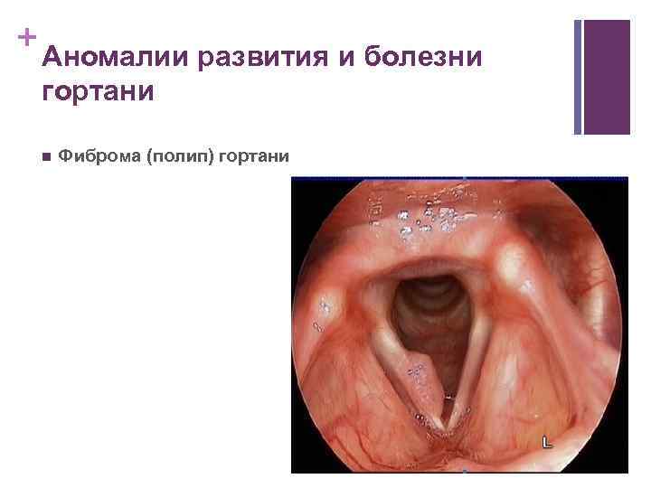 + Аномалии развития и болезни гортани n Фиброма (полип) гортани 