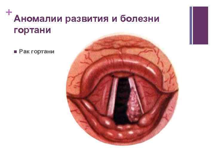 + Аномалии развития и болезни гортани n Рак гортани 