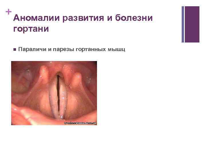 + Аномалии развития и болезни гортани n Параличи и парезы гортанных мышц 