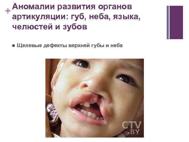 Аномалии развития органов + артикуляции: губ, неба, языка, челюстей и зубов n Щелевые дефекты