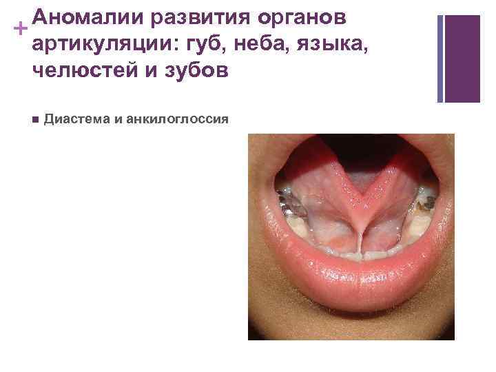 Аномалии развития органов + артикуляции: губ, неба, языка, челюстей и зубов n Диастема и