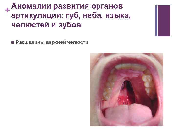 Аномалии развития органов + артикуляции: губ, неба, языка, челюстей и зубов n Расщелины верхней