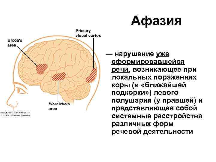 Тотальная афазия