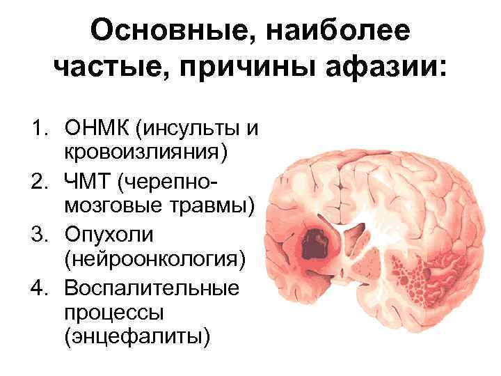 Локальные поражения мозга это. Афазия ОНМК. Причины возникновения афазии. Острое нарушение мозгового кровообращения. Причины острых нарушений мозгового кровообращения.