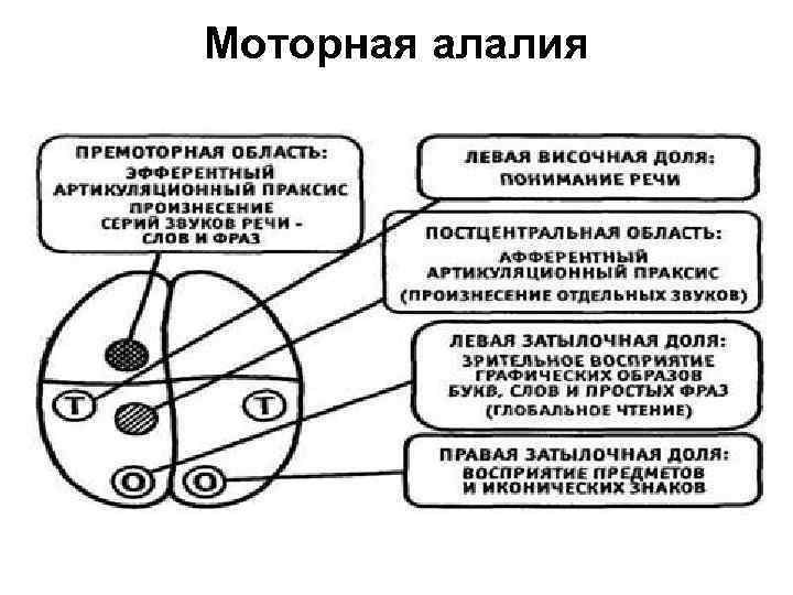 Моторная алалия 