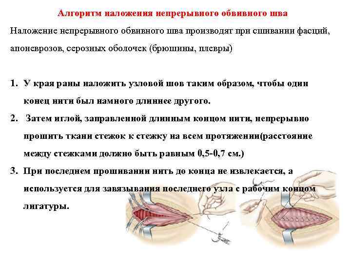 Алгоритм наложения непрерывного обвивного шва Наложение непрерывного обвивного шва производят при сшивании фасций, апоневрозов,