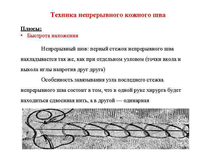 Техника непрерывного кожного шва Плюсы: • Быстрота наложения Непрерывный шов: первый стежок непрерывного шва